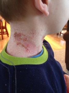 Neck month 4. First thing in the morning.  See all the skin flakes on his pj's